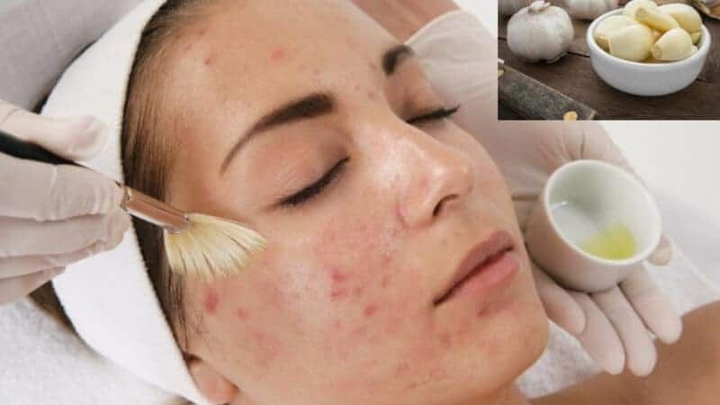 2 công dụng chính của tinh dầu tỏi đối với làn da